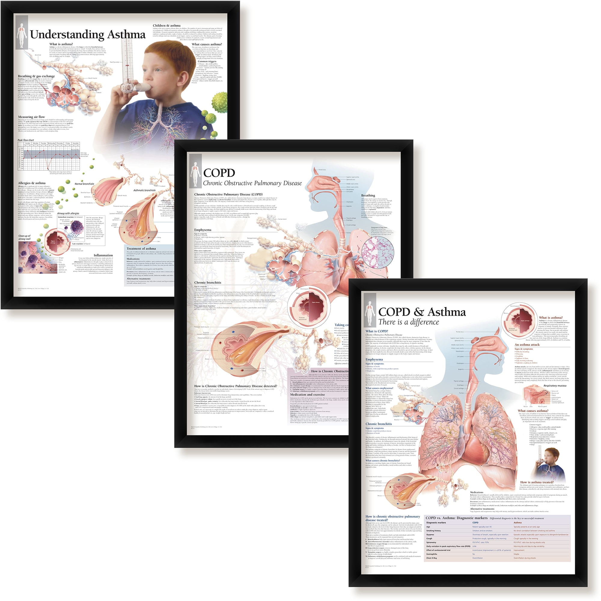 Set Of 3 Framed Medical Posters Understanding Asthma COPD And COPD
