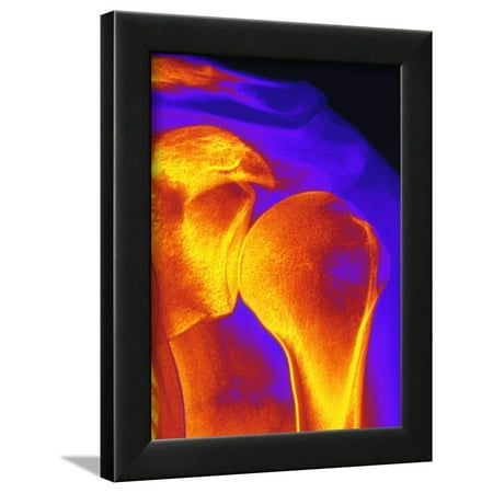 Shoulder Joint X-ray Framed Print Wall Art By PASIEKA