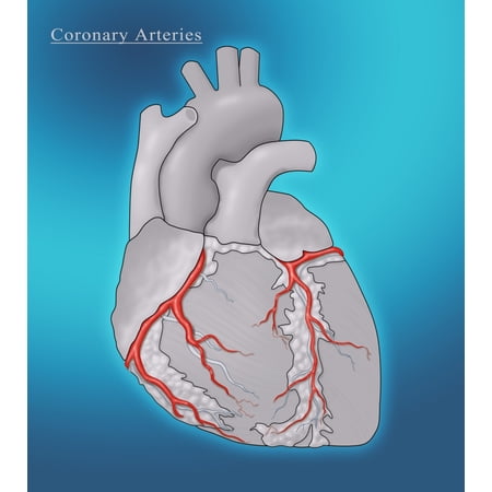 Coronary Arteries Illustration Stretched Canvas - Monica SchroederScience Source (24 x 36)