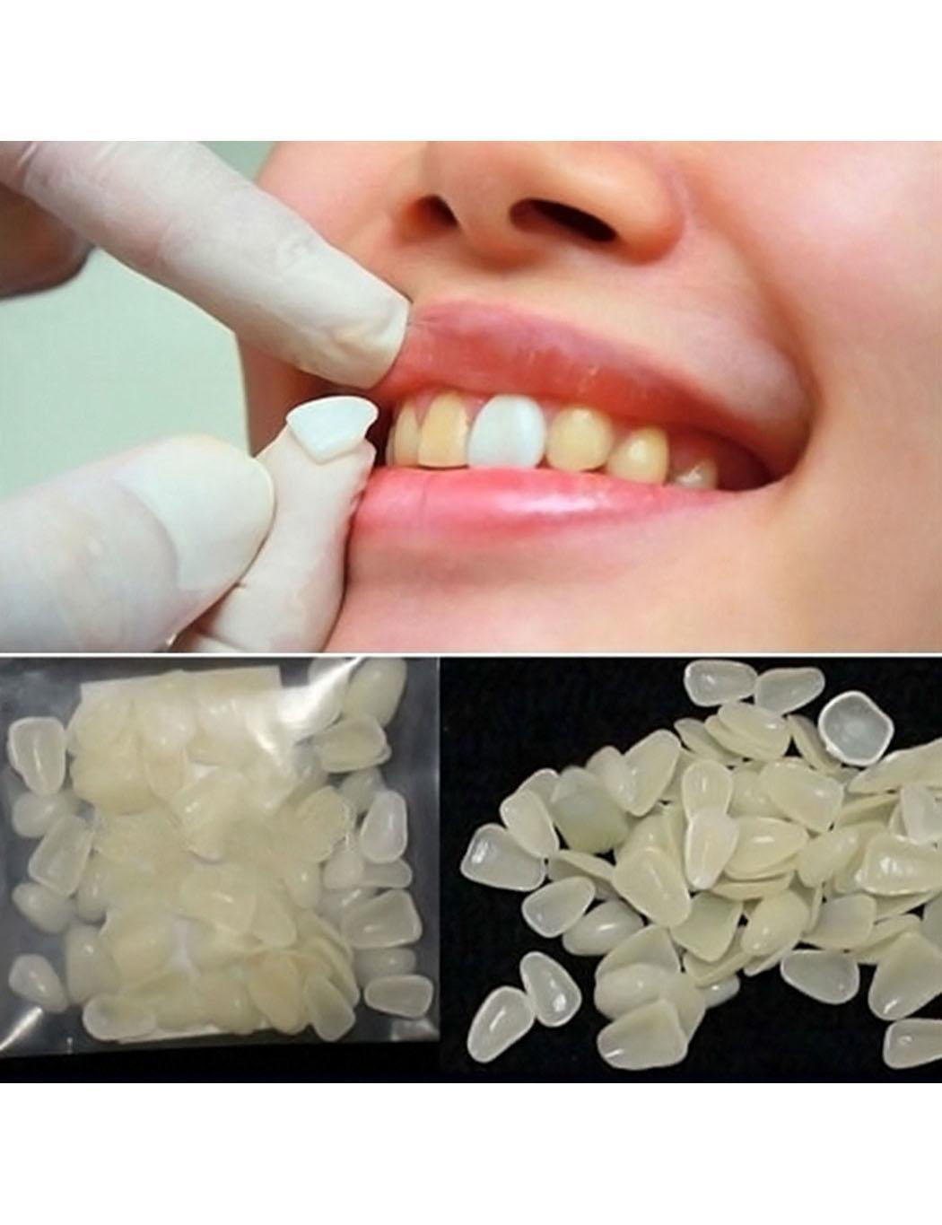 Dental Whitening Veneers UltraThin Resin Teeth Upper Anterior Shade