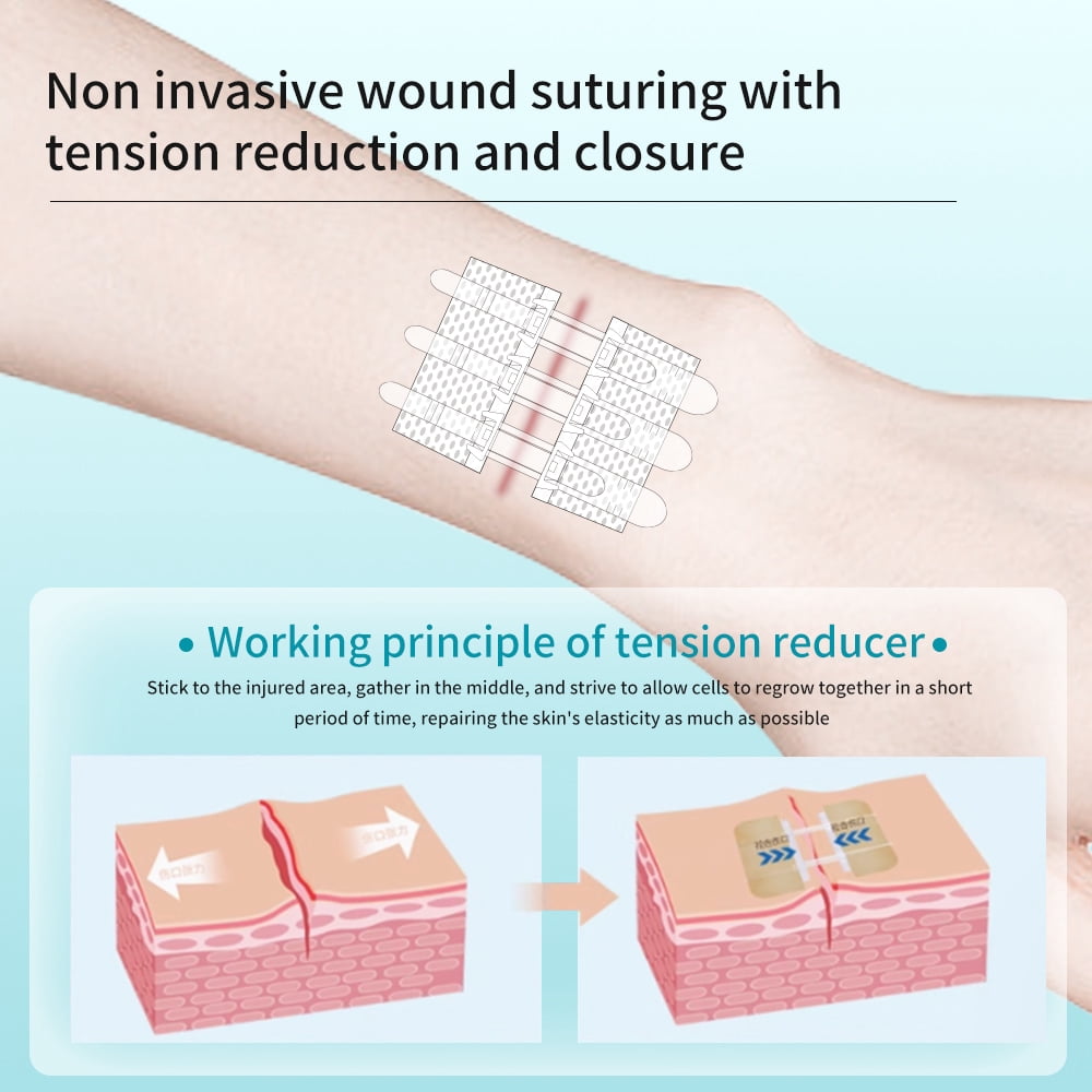 Wound Closure Strips for Emergency First Aid, Butterfly Bandages Suture Alternative, Surgical Laceration Repair Without Stitches or Needles (4 Pack)