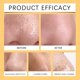 thumbnail image 5 of 30pcs Pore Cleansing Patch, Blackhead Removal Pore Strips, Hydrocolloid Nose Patch Targets Pores & Pimples Deep Cleansing, 5 of 5