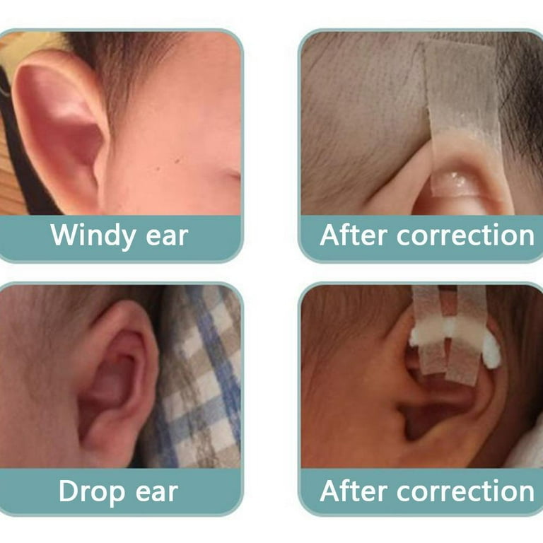 1Roll Ear Aesthetic Corrector Silicone Tape Child Ear Correction Health  C9G8 P8P6