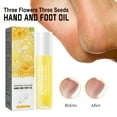 Three Flowers And Three Hand And Foot Oil Itchy Feet Hands Moisturizes