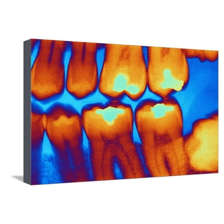 Teeth with Fillings, X-ray Stretched Canvas Print Wall Art By