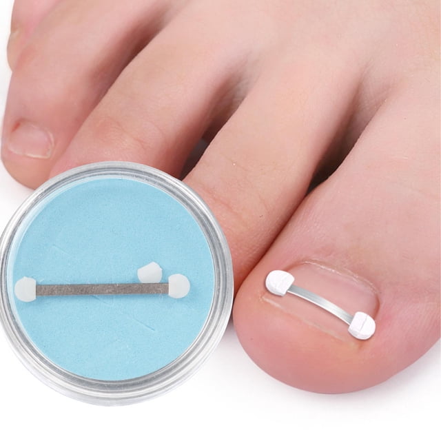 Tiras Correctoras De Uñas Encarnadas, Kit De Eliminación De Uñas Encarnadas Ajustable, Cómodo Corte Libre De Acero Inoxidable Para Uñas Gruesas