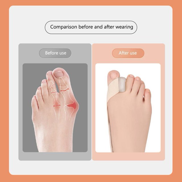 Unisex Hallux Valgus aparato elástico Hallux Valgus órtesis para pie suministros
