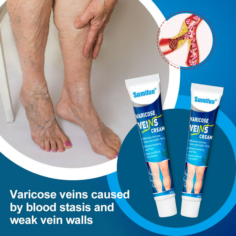  Varicose Veins Treatment for Legs - Healing Natural Oils  Formula, Anti Varicose Vein Soothing Leg Cream, Varicose Veins Treatment  for Legs（1.76 fl oz ） : Beauty & Personal Care
