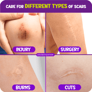 Cicatricure Advanced Scar Gel for Kids, Hypoallergenic Scar Treatment, Grape Scent, 1 oz (1 pack)