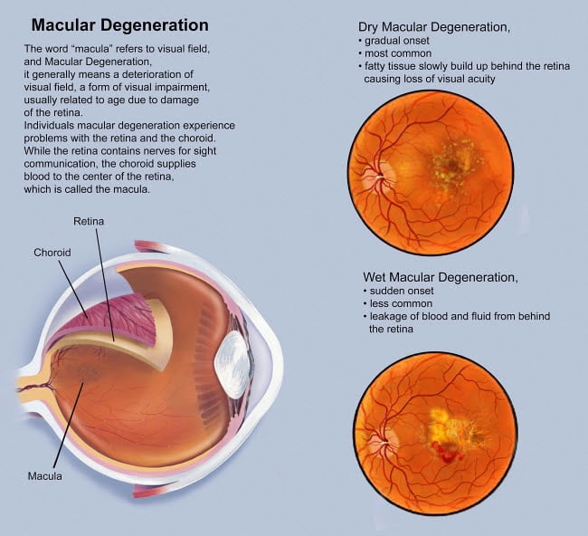 Retina with macular degeneration Poster Print by TriFocal