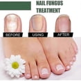 thumbnail image 5 of Nail Fungus Treatment, 50ml Toenail Fungus Treatment, Extra Strong Nail Repair Solution with Natural Tea Tre, 5 of 5