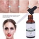thumbnail image 3 of Esencia De Suero Facial De Té, Hidrata Y Nutre La Piel, Elimina Las Marcas De Acné, 30 Ml, 3 of 7