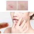 thumbnail image 5 of Parche para espinillas Parche para el acné facial amigable con la piel Compatible con, 5 of 5