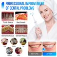 thumbnail image 3 of Eliminador de cálculo dental ultrasónico eléctrico, limpiador de dientes, limpieza dental, escalador para blanquear los dientes, eliminador de sarro dental, irrigador oral, 3 of 5