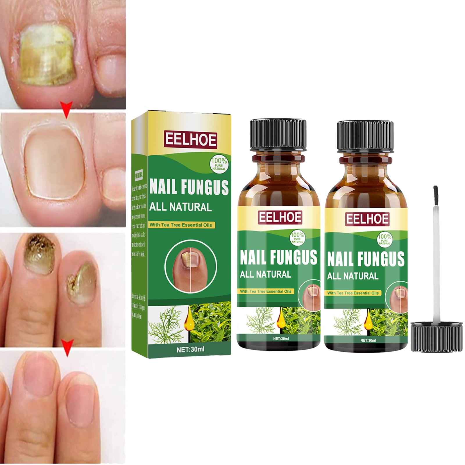 2Pack Toenail Fungus Treatment, Extra Strength Tea Tree Oil Nail Fungus  Treatment for Toenail, Nail Repair for Damaged, Broken, Cracked &  Discolored Nails 