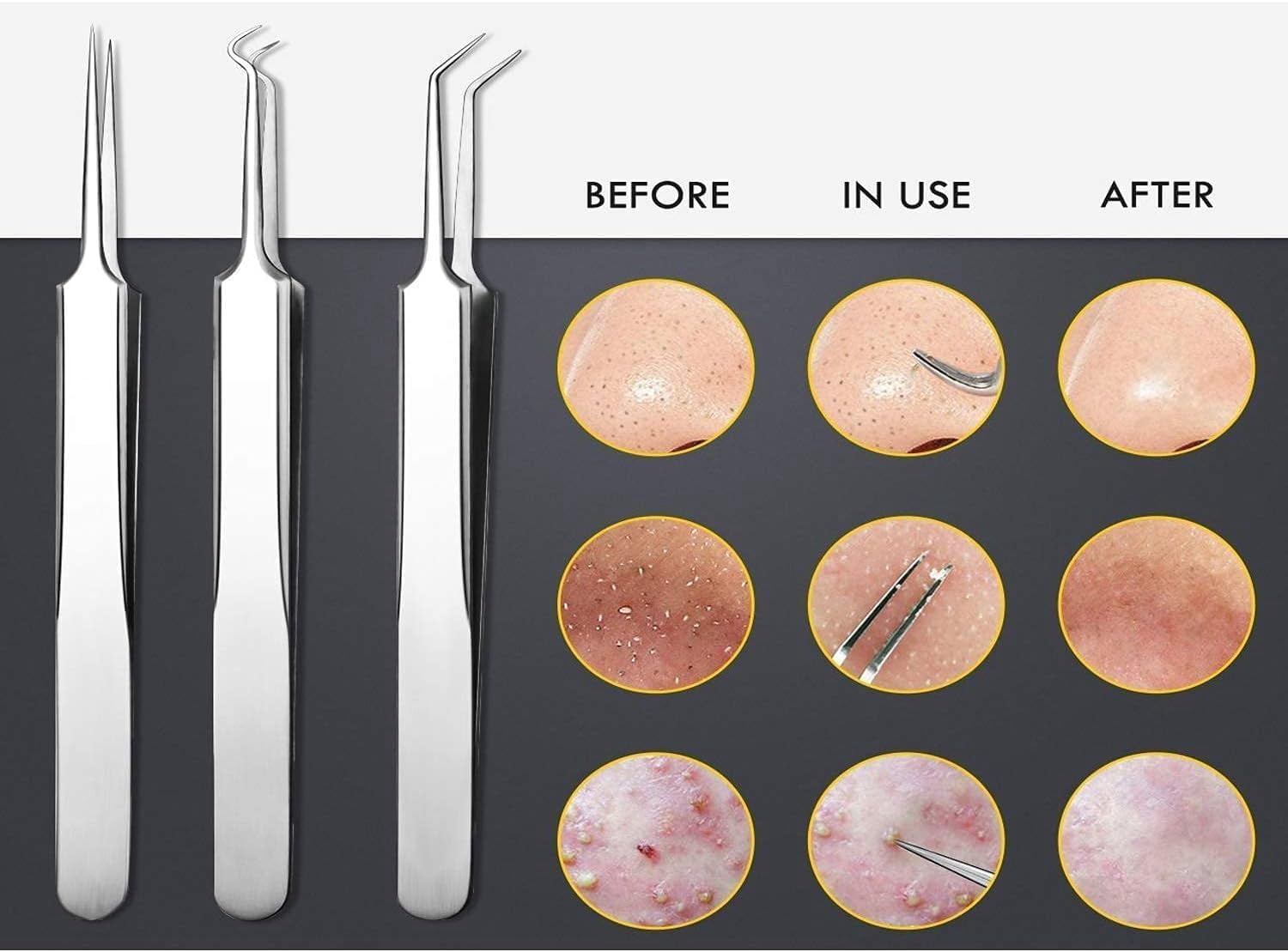 Blackhead Remover Tweezer Kit, 8 Pcs, Comedone Extractor, Whitehead Acne Blemish Pimple Remover