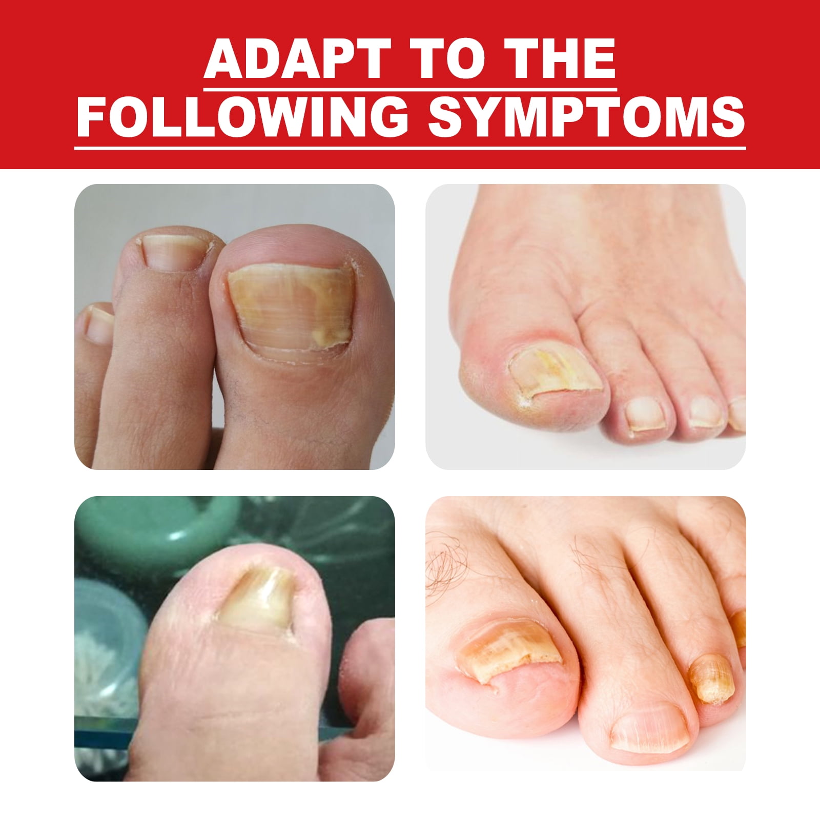 Alvantor Ingrown Toenail Essence Moisturizing Nail Care Oil for Damaged Toenails, 10ml