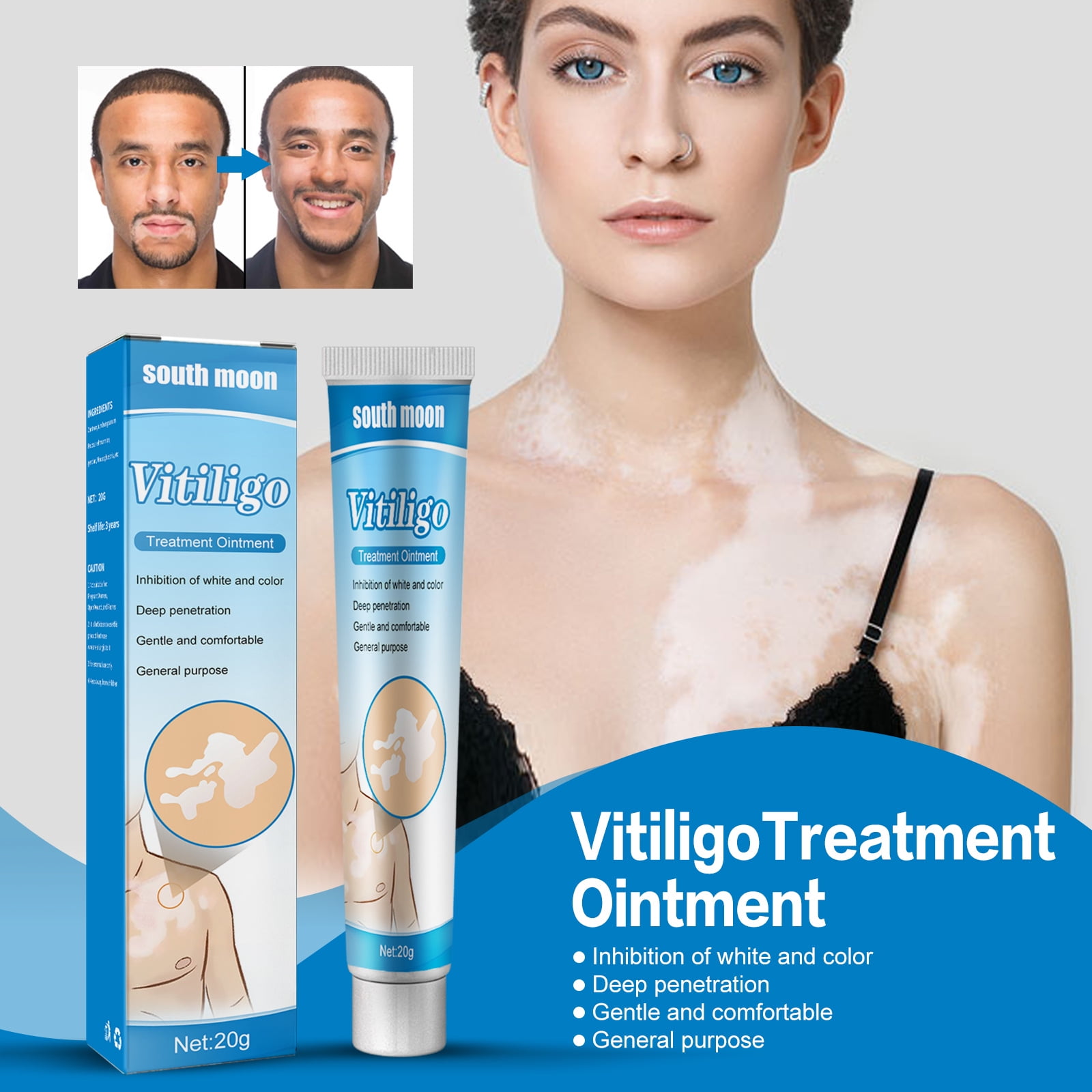 Vitiligo Cream White Spots Vitiligo Therapy Ointment Moisturizing