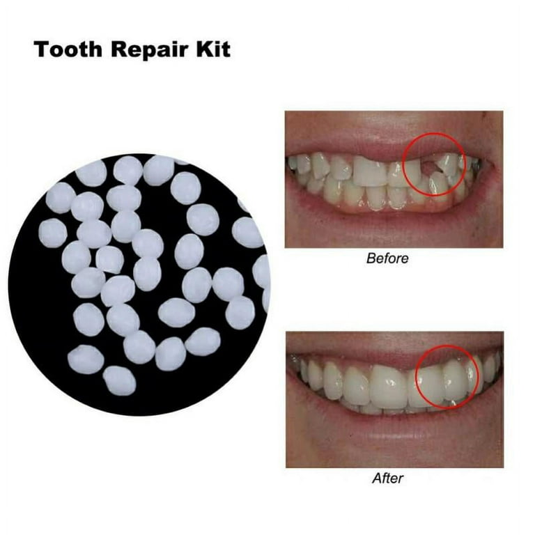 Temporary Teeth Repair Kit, Moldable False Teeth Tooth Repair Granules, Temp  Tooth Beads with 4 Dental Tools, Snap On Instant and Confident Smile