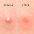 thumbnail image 4 of Rael Hydrocolloid Acne Pimple Healing Patch (2 Pack), 4 of 6
