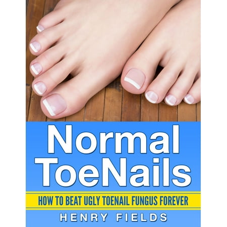 Normal ToeNails: How to Beat Ugly Toenail Fungus Forever -
