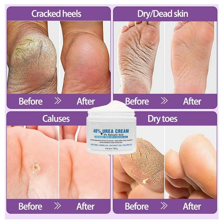 Bkbp Urea Cream 40 Percent for Feet - Cream with 2 Bkbp Urea Cream 40 Percent for Feet - Cream with 2