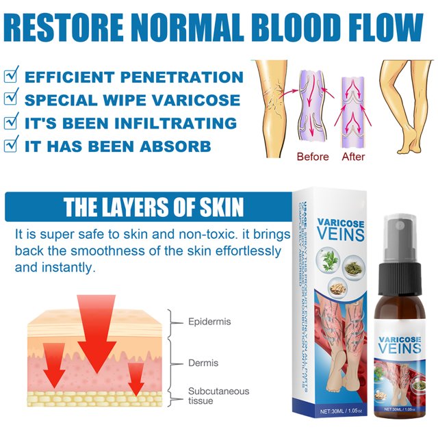 Paquete De 3 Aerosoles Para Venas Varicosas, 30ml, Aerosol De Hierbas Naturales Para La Eliminación De Venas Varicosas Y Arañas Vasculares, Mejora La Circulación Sanguínea ANGGREK Varicose Veins Spray
