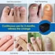 thumbnail image 2 of Nail Fungu Cleaning Light Device Nail Fungu Treatments B, 2 of 5