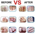 thumbnail image 3 of Crema eficaz Casa de los Tesoros Tratamiento de hongos en las uñas Gel antiinfección 20g, 3 of 3