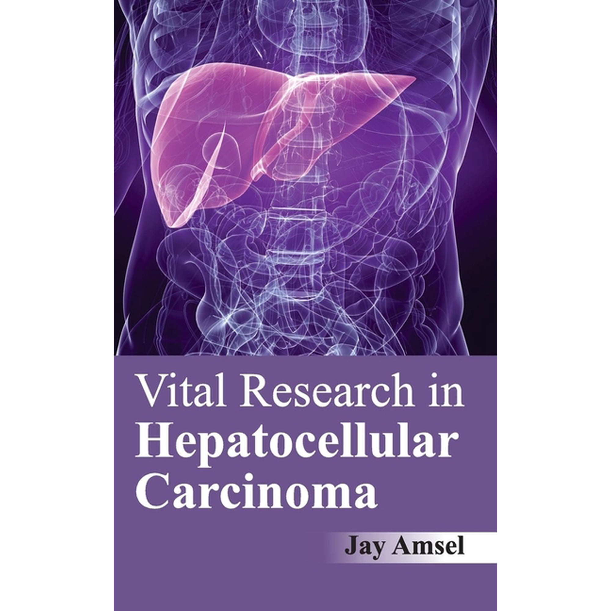 Vital Research in Hepatocellular Carcinoma (Hardcover)