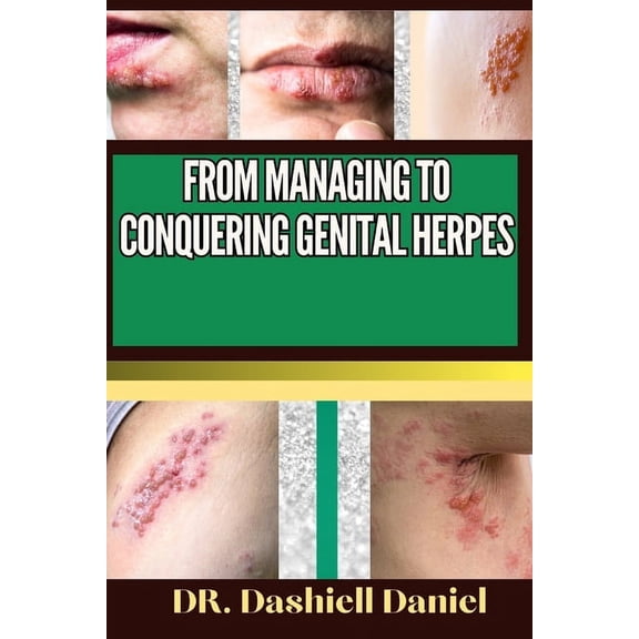 From Managing to Conquering Genital Herps: Expert Guide To Understanding the Causes, Recognizing Symptoms, Prevention and Embracing Effective Treatments for a Vibrant and Healthy Life (Paperback)