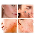 thumbnail image 3 of OUKEYA Hydro Clear Patches for Sensitive Skin Overnight Treatment 36 Pcs, 3 of 8