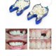 thumbnail image 1 of veneers for missing teeth temporary denture braces, 1 of 4