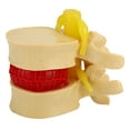 thumbnail image 2 of Modelo De Hernia De Disco Lumbar Humano, Portátil Profesional Práctico 1:1.5 Vértebras Lumbares Humanas Degenerativas, Enseñanza Clínica Para Ortopedia, 2 of 7