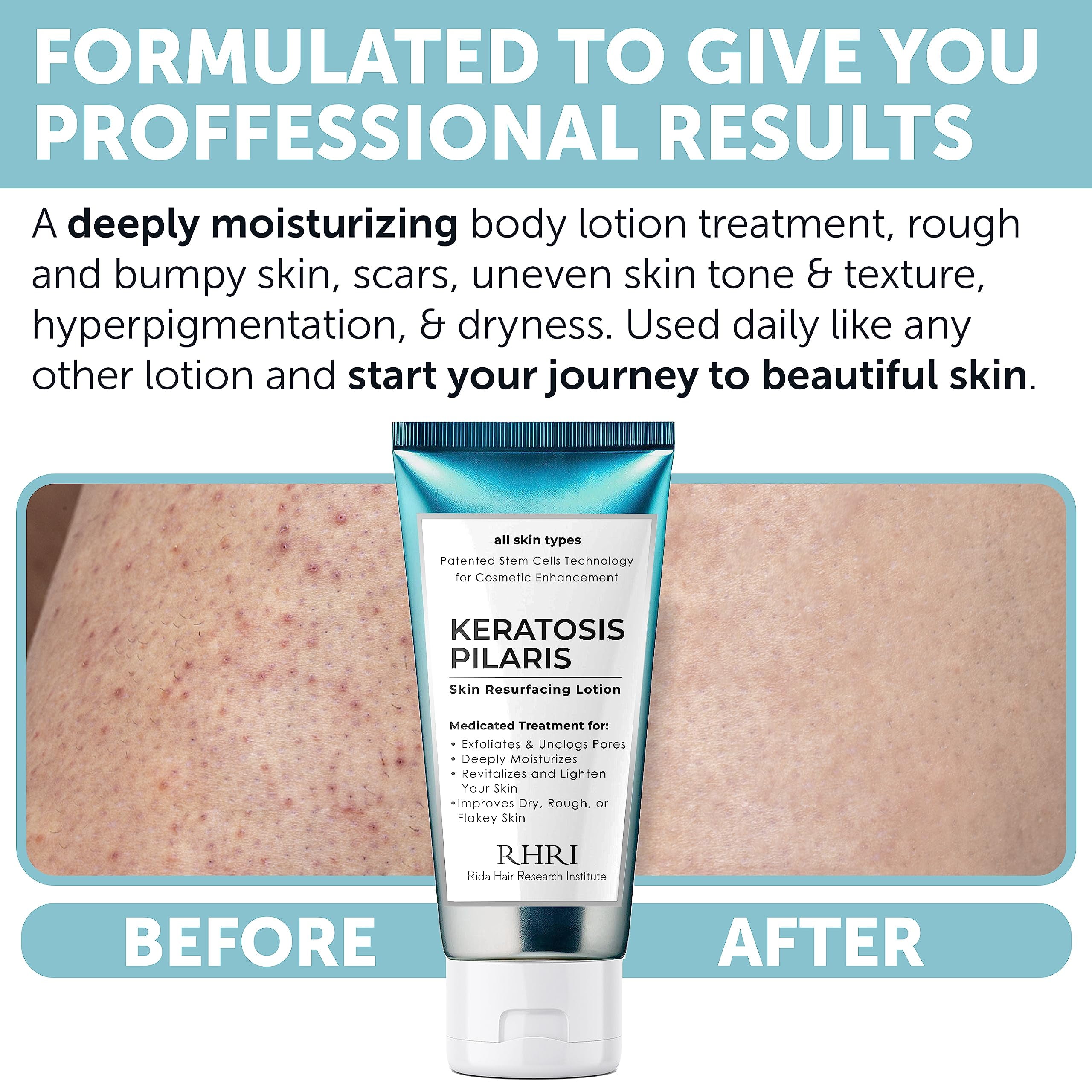KP Bump Eraser Lotion Keratosis Pilaris Lotion with Glycolic Acid, AHA & BHA Exfoliating Rough & Bumpy Skin Body Lotion