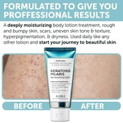 KP Bump Eraser Lotion Keratosis Pilaris Lotion with Glycolic Acid, AHA & BHA Exfoliating Rough & Bumpy Skin Body Lotion