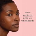 thumbnail image 4 of Miracle Invisible Spot Cover - Hydrocolloid, Acne Pimple Absorbing Cover, Blemish Spot, Skin Care, Facial Stickers, 2 Sizes (96 Count), 4 of 5