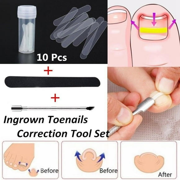 Corrección Del de La Etiqueta Engomada Del Tratamiento de La Abrazadera Del Clip Del Enderezamiento de La Uña Del Del Pie Encarnada Salvador corrector de uñas encarnadas
