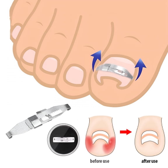 XIRQI Ingrown Toenail Corrector Correction Tool Foot Care Orthotic Pedicure