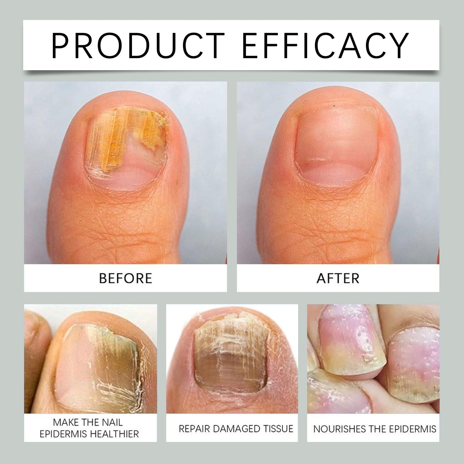 Alvantor Fungus Nail Treatment with Ginger, 7days Nail Growth Serum Solution, 1fl.oz