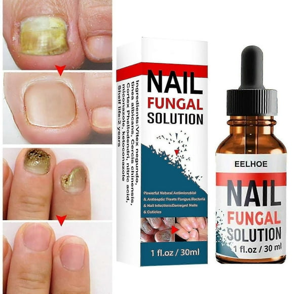 Fungal Nail Repair Treatment Hand & Foot Grey Nail Care Repair Grey Nail Solution Anti-Fungal Liquid for Thickened Yellow Nails