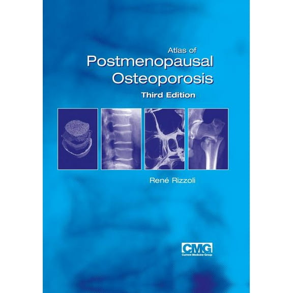 Atlas of Postmenopausal Osteoporosis: Third Edition, (Paperback)