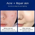 thumbnail image 4 of 2 Pack Acne Removal Nicotinamide Cream Aloe Vera Oil Control Shrink Pores, 4 of 7
