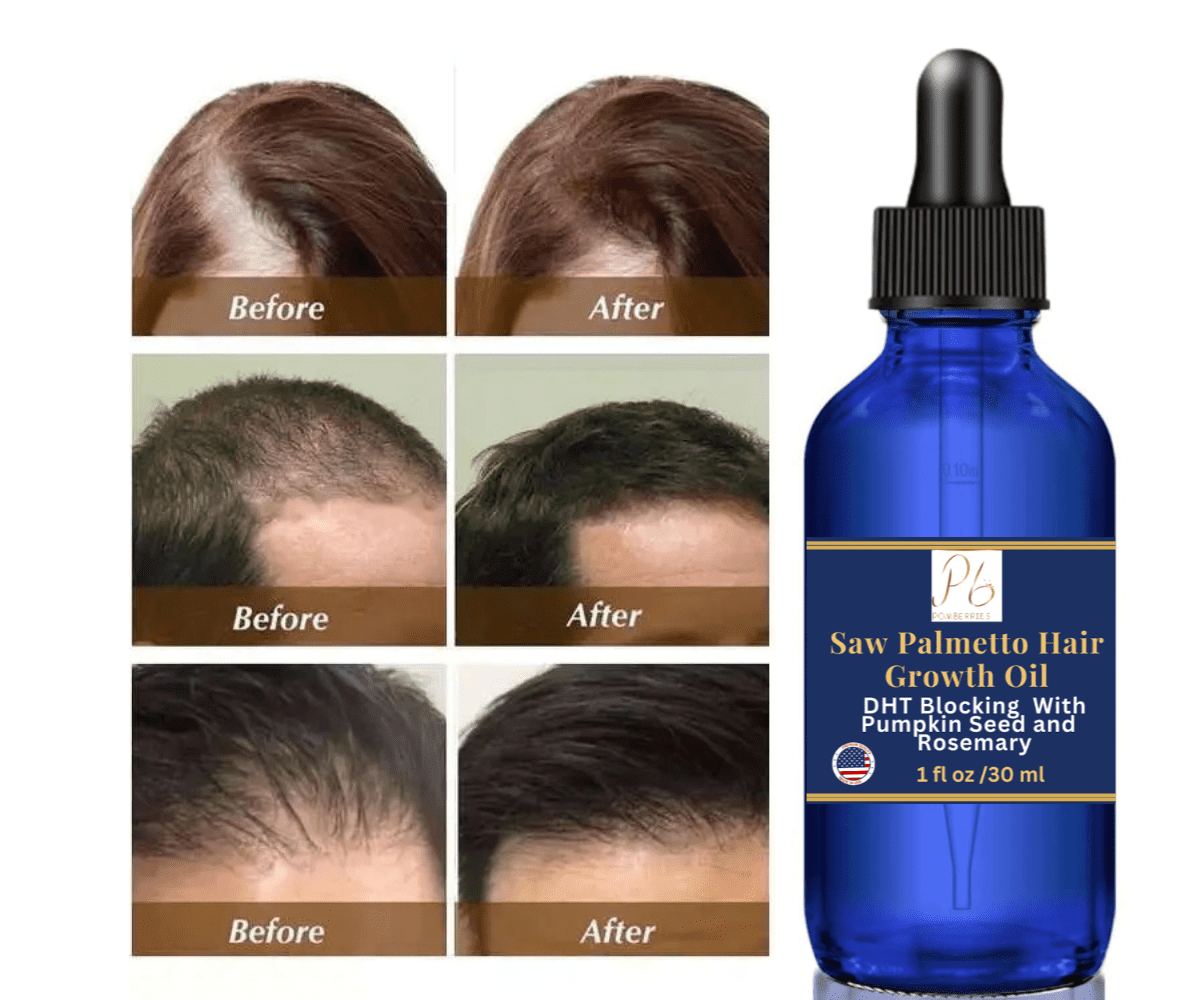 DHT Blocker -has Biotin And Saw Palmetto For Hair Regrowth in Spintex - Hair  Beauty, Hair Growth Expert | Jiji.com.gh