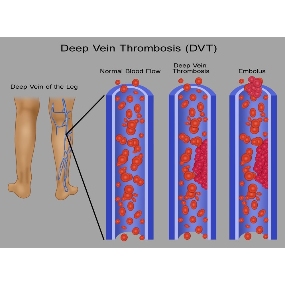 Leg Blood Clots Poster Print by Gwen Shockey/Science Source (36 x 24