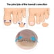 thumbnail image 4 of 12 Unids / Box Incrustación Corrector de Fijación de uñas de los pies 6 Tamaños Ingrown Toe Corre Irfora Herramienta de uñas, 4 of 7