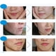 thumbnail image 2 of Crema de eliminación de cicatrices de acné facial BIOAQUA 4 en 1 100 g+30 g+30 ml, 2 of 9