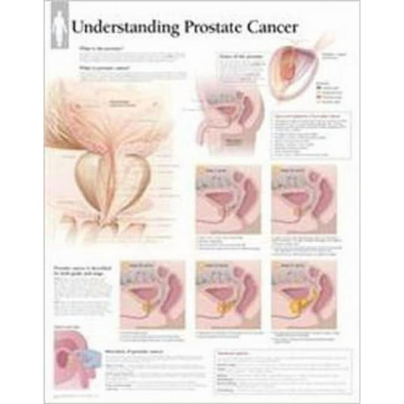 Understanding Prostate Cancer Wall Chart (Wallchart)