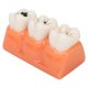 thumbnail image 1 of Modelo de caries dental, Caries dental de resina Modelo de caries de dientes Tiempos Modelo de caries Características líderes en su clase, 1 of 5