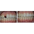 thumbnail image 3 of Reparación de encías con dientes sólidos Brackets caseros para dentaduras postizas Brackets de vampiro Brackets de tigre, 3 of 5